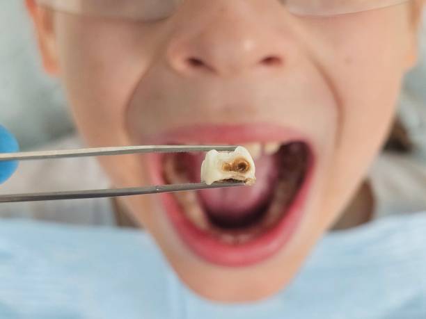 Best Urgent Care for Lost Fillings or Crowns in Capitol Heights, MD